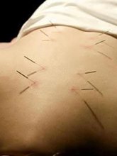 Acupuncture Boca Raton