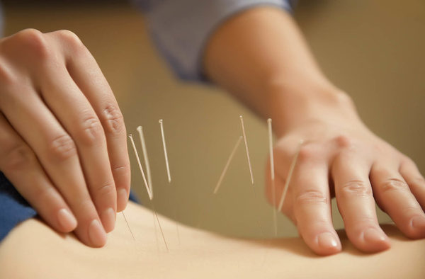 The Wonderful Benefits of Acupuncture