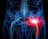 Benefits of acupuncture for sciatica