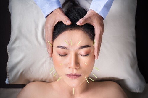 5 Benefits of Cosmetic Acupuncture and Why You should Get It