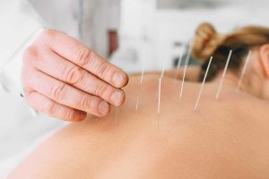 Acupuncture for Back Pain - An Effective and Low-Risk Treatment Option
