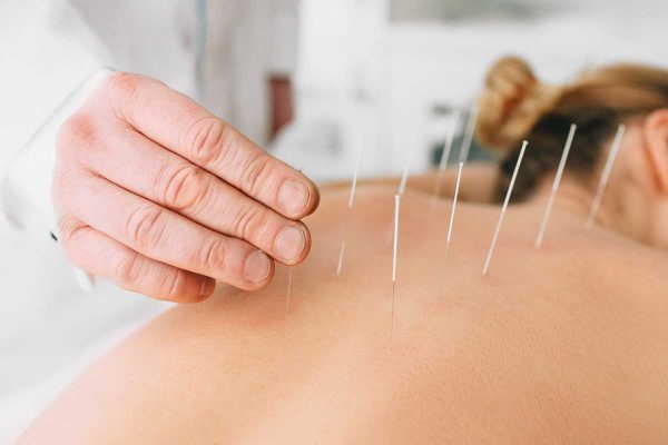Acupuncture for Back Pain: An Effective and Low-Risk Treatment Option