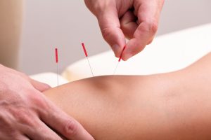 Acupuncture for Knee Pain in Athletes - An Effective Treatment Option