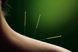 Acupuncture for Neck Pain - A Comprehensive Guide