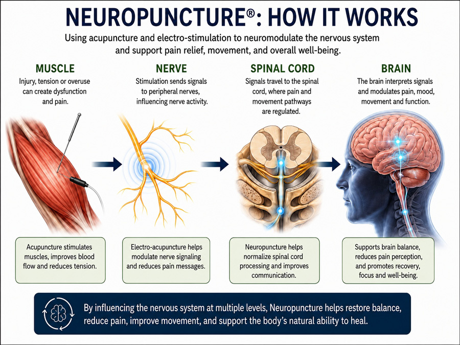 how neuropuncture works infographic
